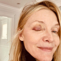 Michelle Pfeiffer got a black eye playing pickleball