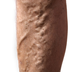 3 in 10 suffer with varicose veins